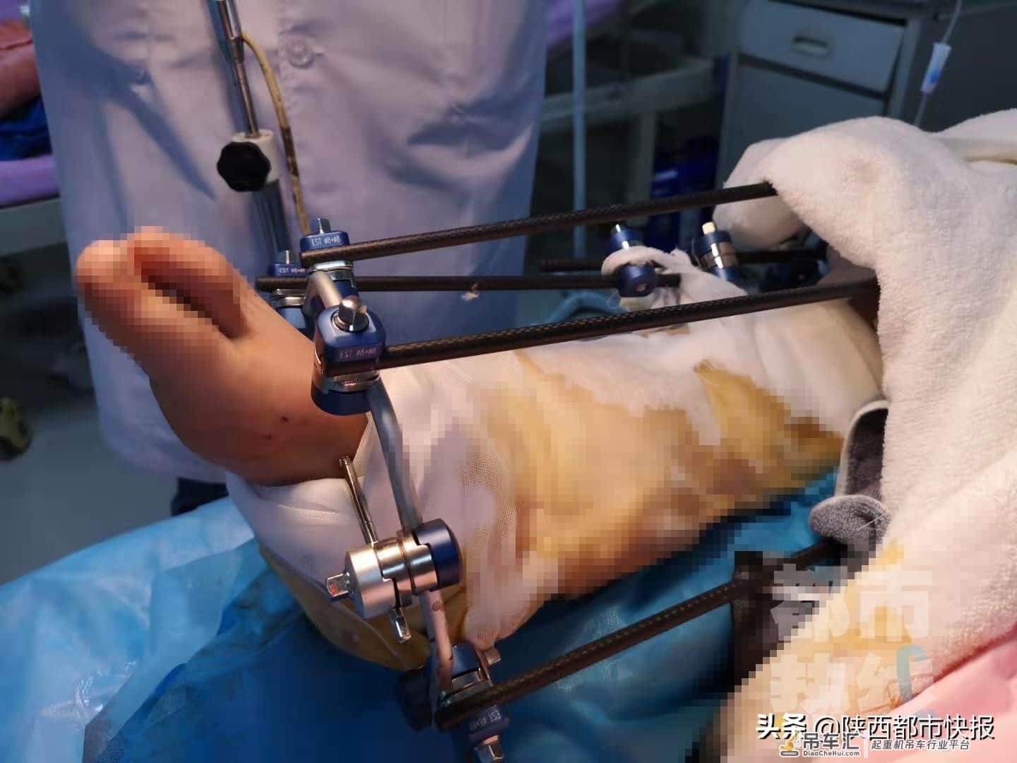 吊起的灯杆半空中掉落 西安29岁安装工人右腿被砸断