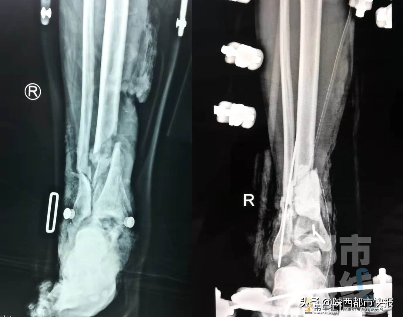 吊起的灯杆半空中掉落 西安29岁安装工人右腿被砸断